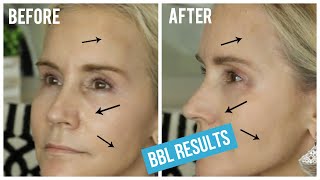 BBL LIGHT TREATMENT BEFORE AND AFTER  MY BBL LASER TREATMENT FOR BROWN SPOTS amp SPIDER VEINS [upl. by Suoicserp]