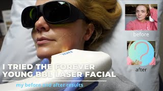 I TRIED THE FOREVER YOUNG BBL LASER FACIAL  HERE ARE MY RESULTS [upl. by Kassab110]